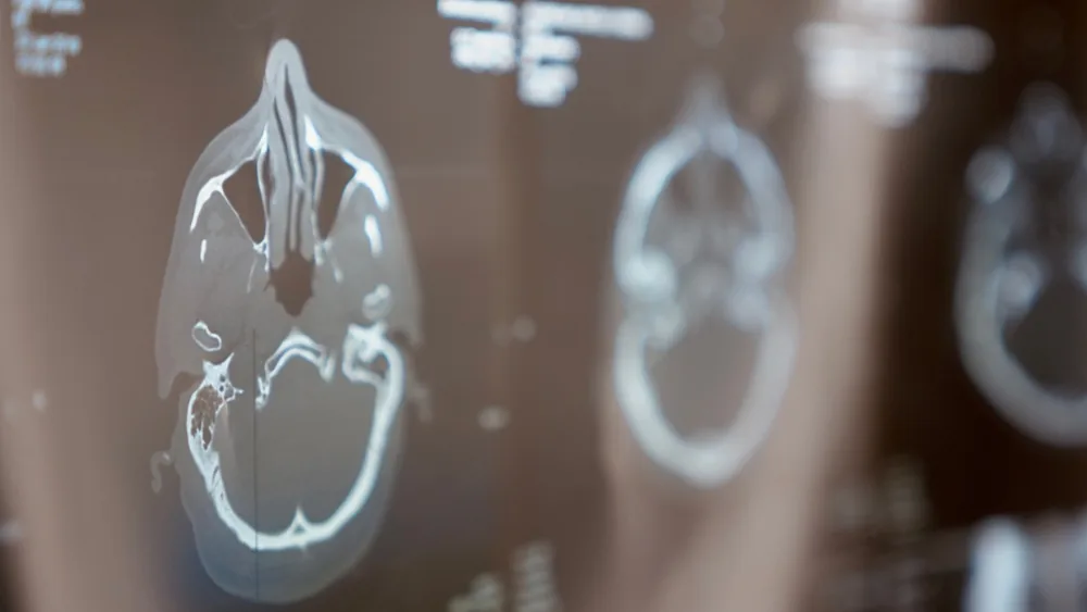 Resonancia magnética (RM) de una lesión cerebral traumática (LCT)