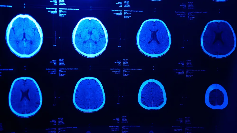 Resonancia magnética después de una lesión cerebral traumática.