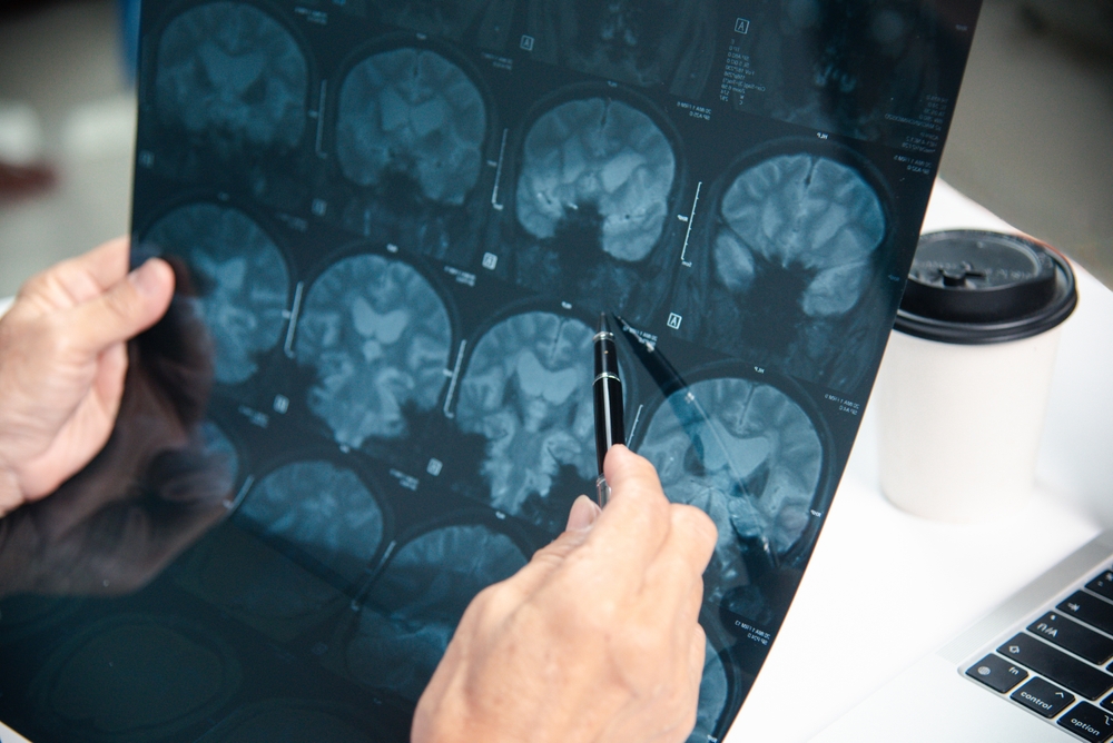 Doctor looks at brain MRI.