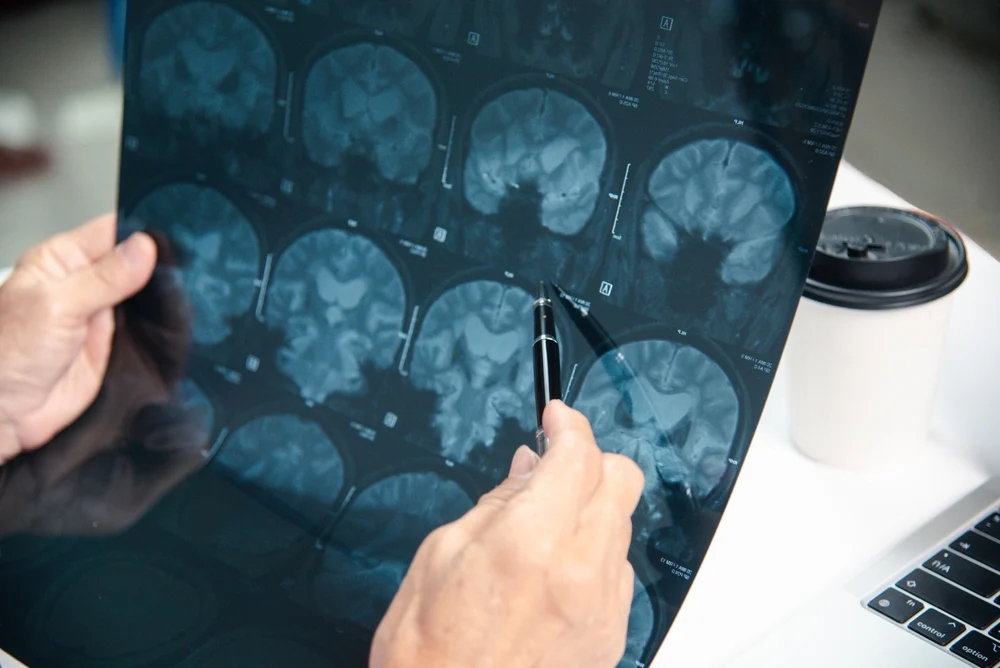 Doctor looks at brain MRI.