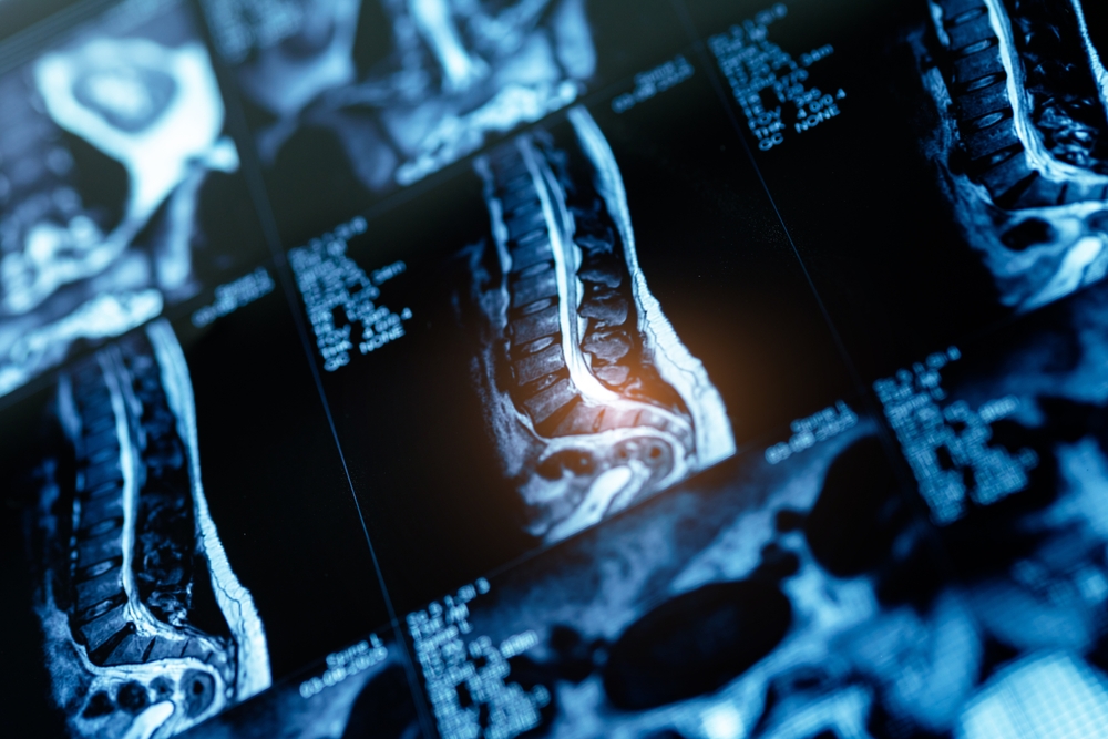 Spinal injury scan.