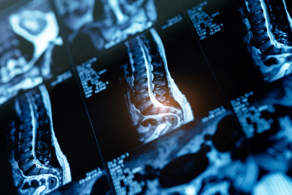 Spinal injury scan.