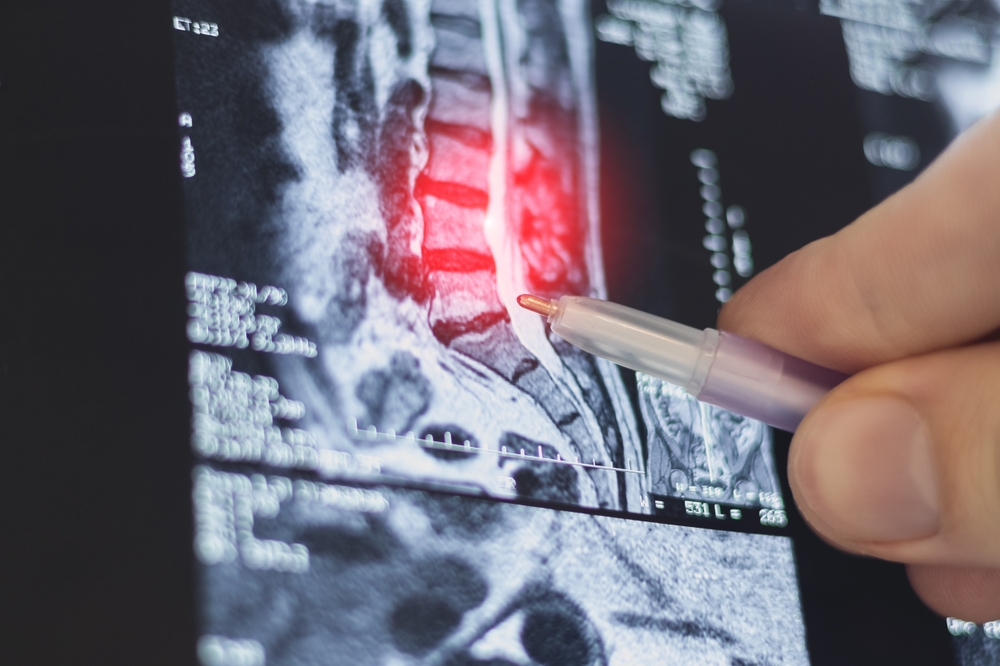 X-ray showing a herniated disc.